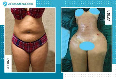 Can You Walk Right Away After Liposuction On Thighs? - Jaime