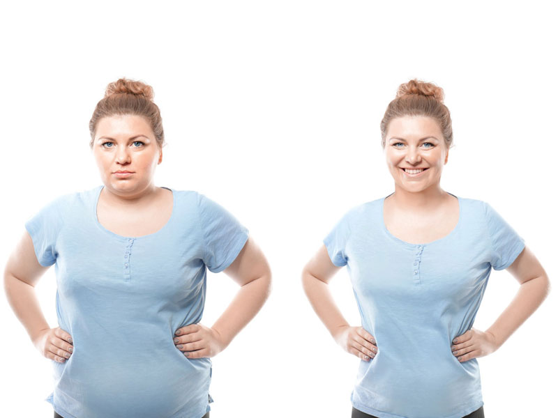 woman before and after weight loss surgery