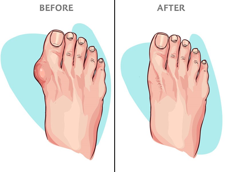 illustration of before and after bunion removal surgery