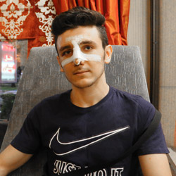 Azad Isaa Nose Job Surgery in Tehran