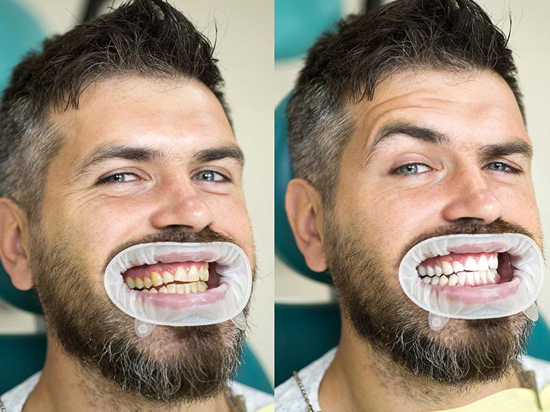 man having teeth whitening mouth guard in place before and after his teeth being whitened