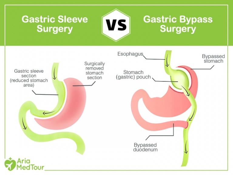 Gastric Bypass Vs Gastric Sleeve: A Close Comparison | AriaMedTour