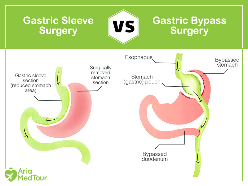infographic showing the difference between gastric sleeve and gastric bypass