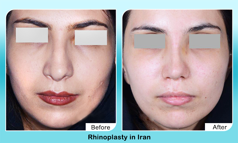 rhinoplasty in Iran before after results
