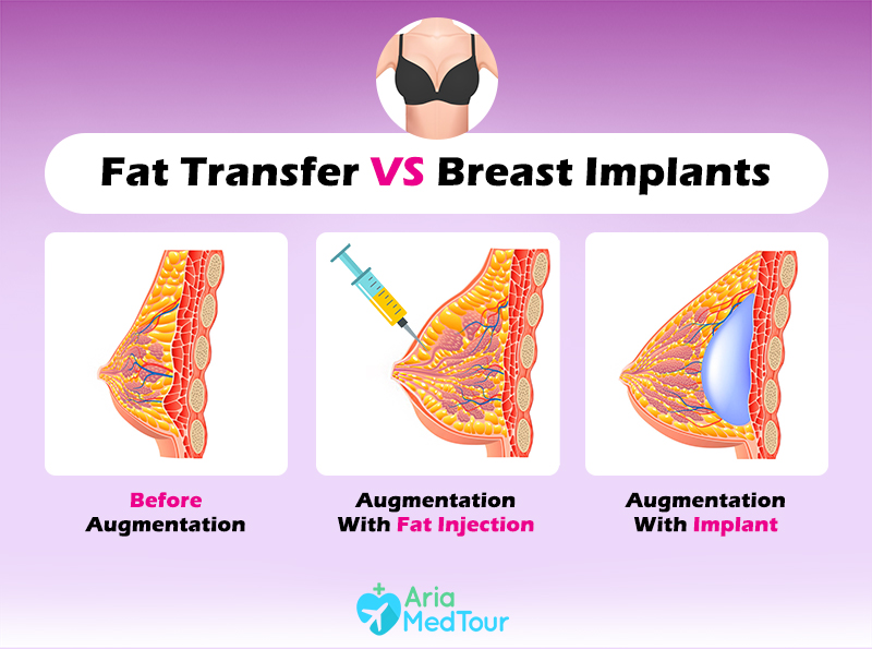 Choosing the Right Breast Enhancement: Fat Transfer or Implants