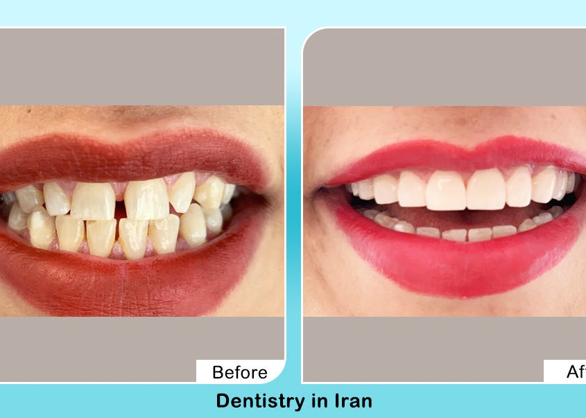 Hollywood smile before after in Iran