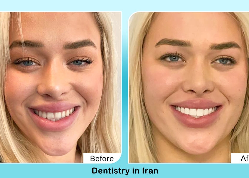 Cosmetic dentisrty by AriaMedTour before after
