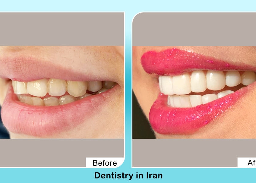 Cosmetic dentistry in Iran before after