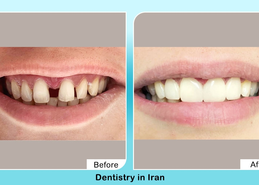 Veneers in Iran before after