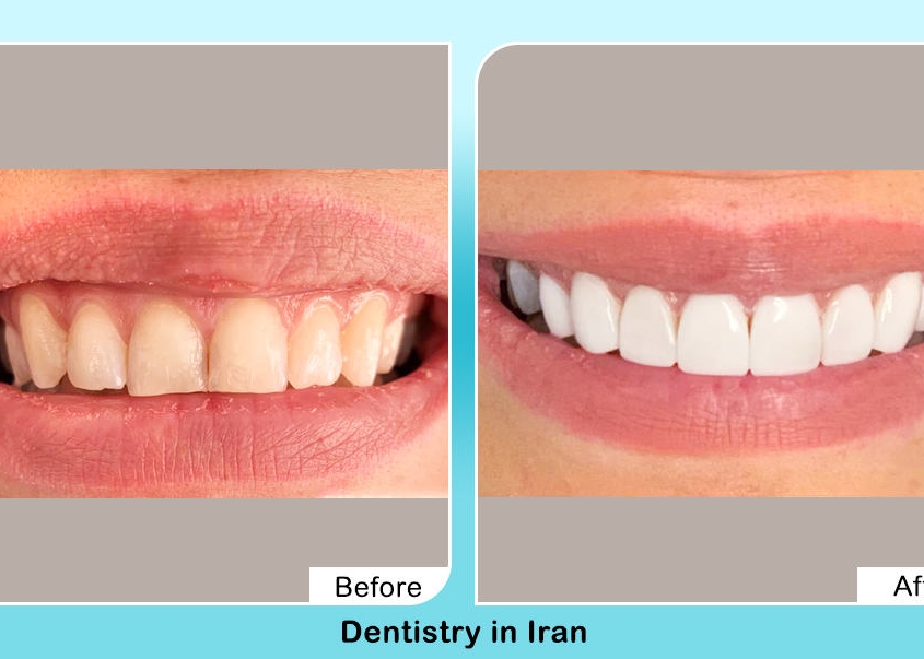 Veneers in Iran before after