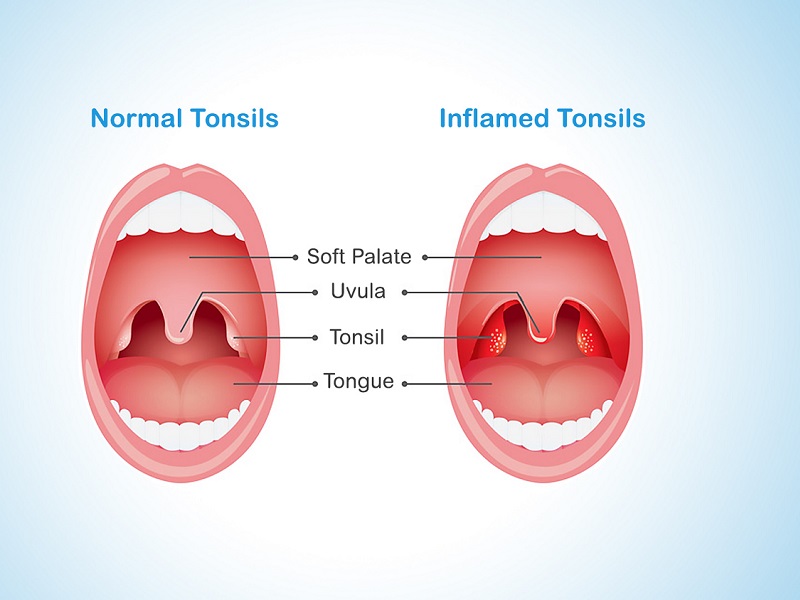 Tonsillectomy And Adenoidectomy In Iran Ariamedtour