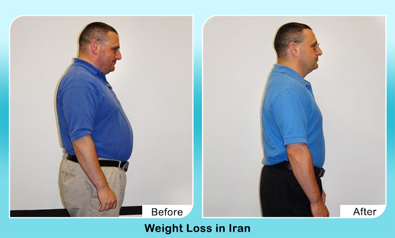 weight loss surgery before and after in Iran