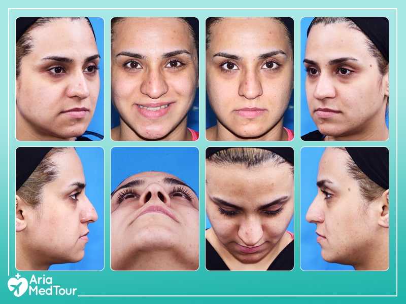 our rhinoplasty patient photos from different angles
