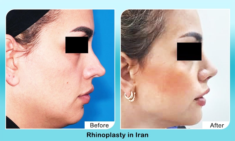 nose job in Iran before and after