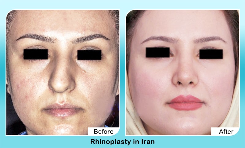 Nose job in iran before and after