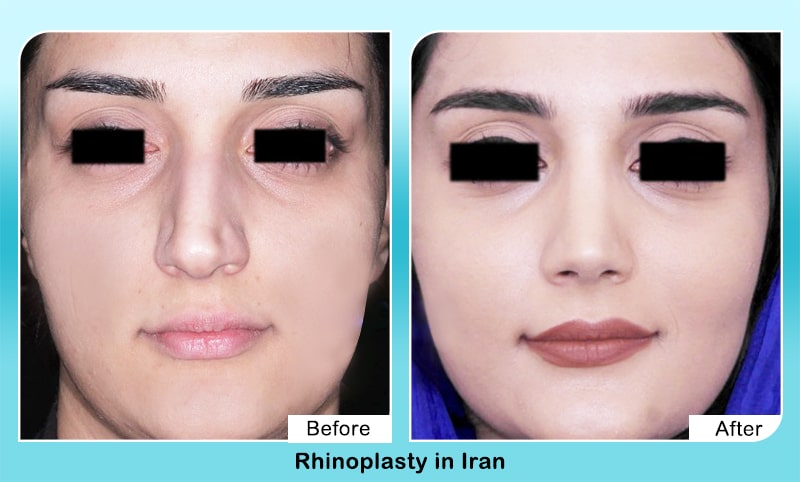 rhinoplasty in Iran before after surgery results
