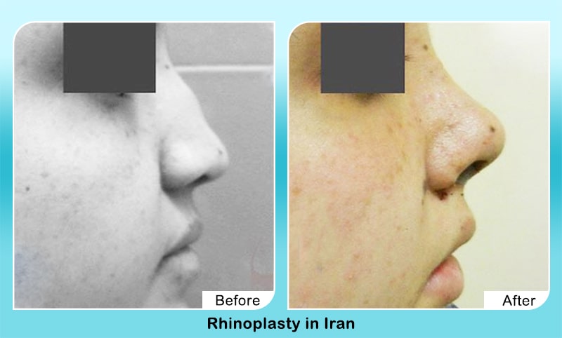 Nose job in Iran before and after