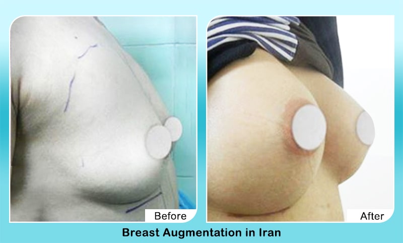 Breast implants in iran before after