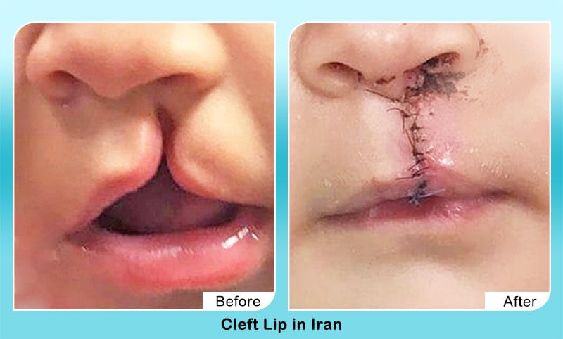 cleft palate in iran before and after