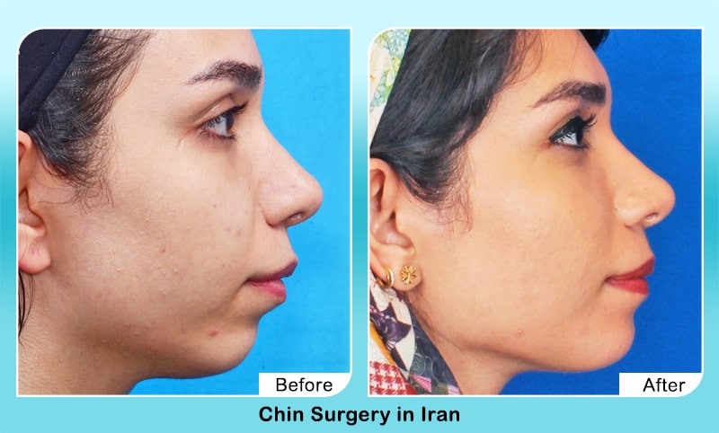 rhinoplasty in Iran before after surgery results
