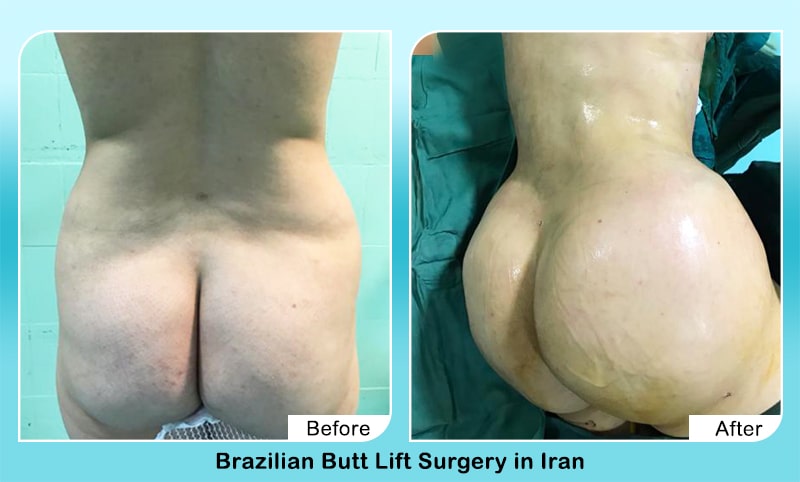Butt augmentation in iran before after