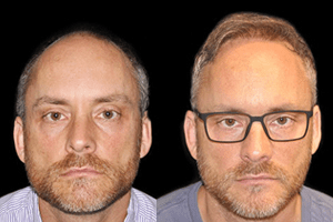 hair transplant before after photos
