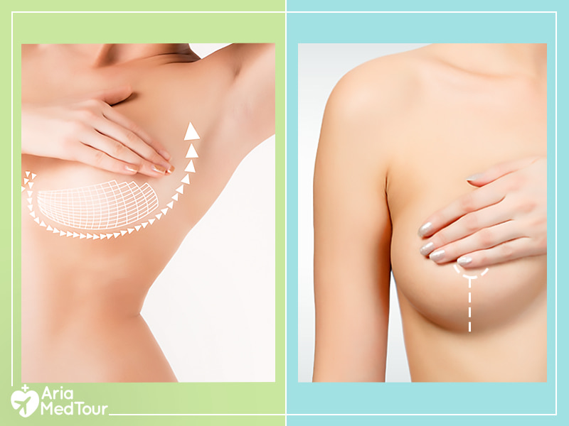 The difference between breast implant and breast lift surgery