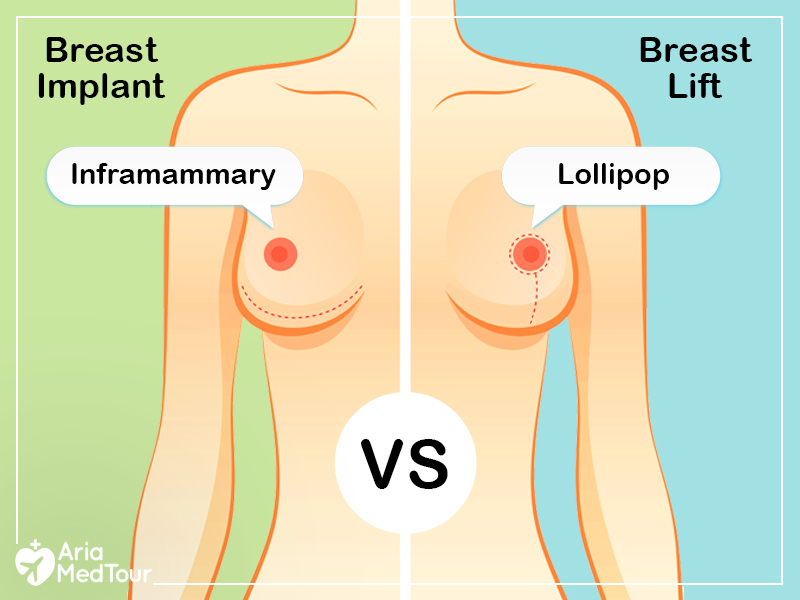 Breast Implants Vs Breast Lift: The Differences and Similarities