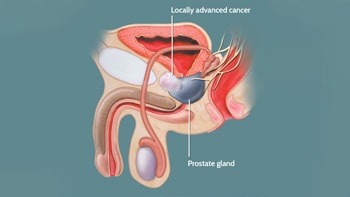 Prostate cancer treatment in Iran