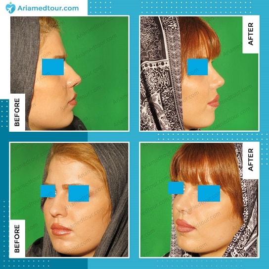 nose job in Iran rhinoplasty before after dr. Boromand Ariamedtour