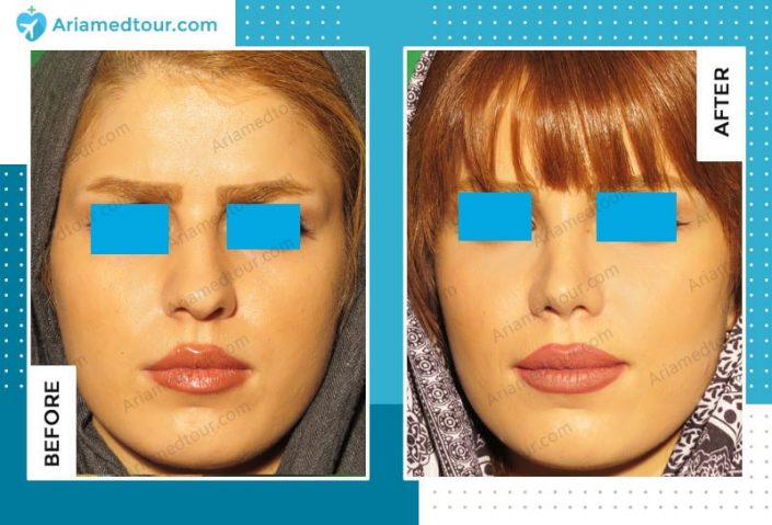 nose job in Iran rhinoplasty before after dr. Boromand Ariamedtour