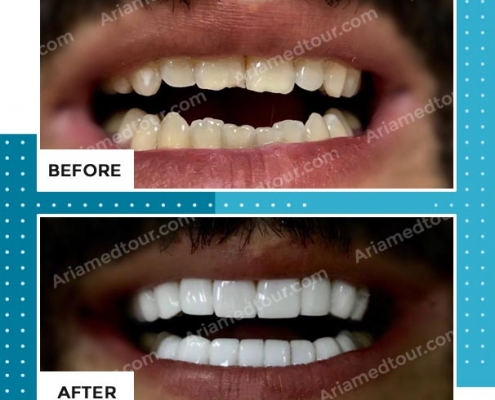 dentistry before after photo in iran