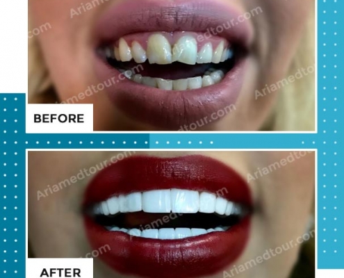 dentistry before after photo in iran