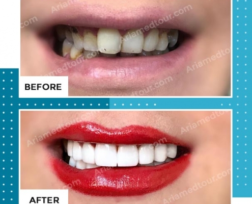 dentistry before after photo in iran