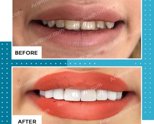 dentistry before after photo in iran