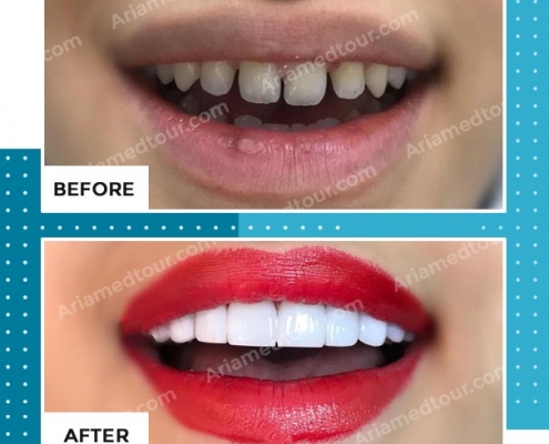 dentistry before after photo in iran