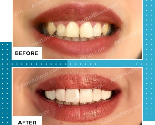 dentistry before after photo in iran