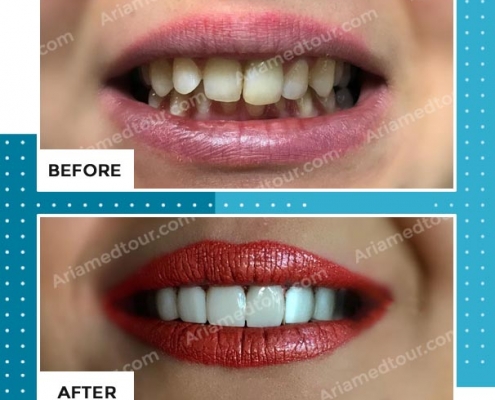 dentistry before after photo in iran