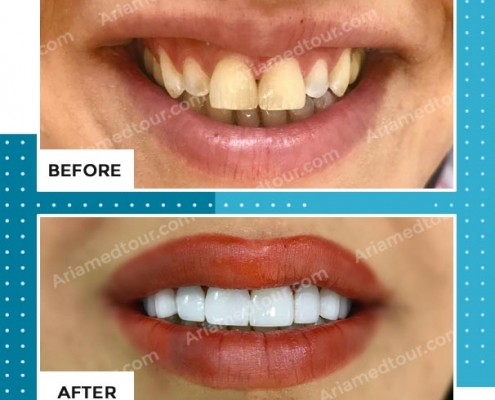 dentistry before after photo in iran