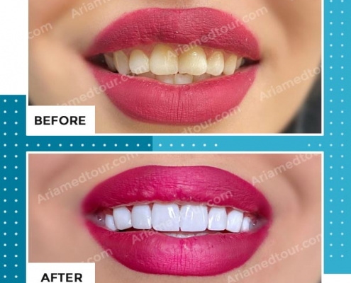 dentistry before after photo in iran