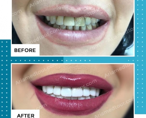 dentistry before after photo in iran