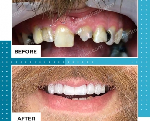dentistry before after photo in iran
