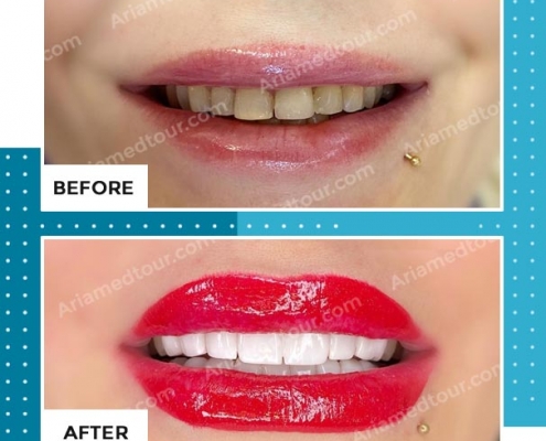 dentistry before after photo in iran