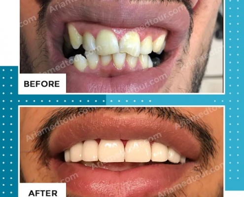 dentistry before after photo in iran