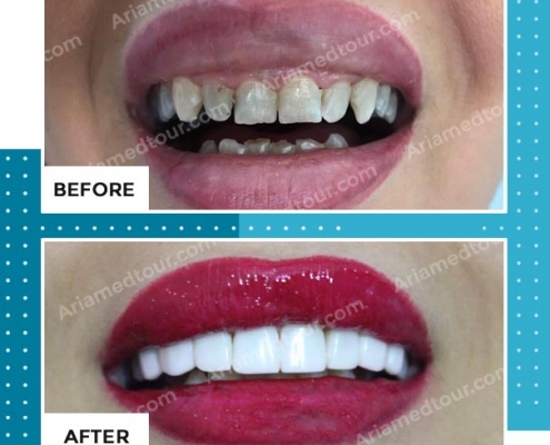 dentistry before after photo in iran