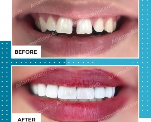dentistry before after photo in iran
