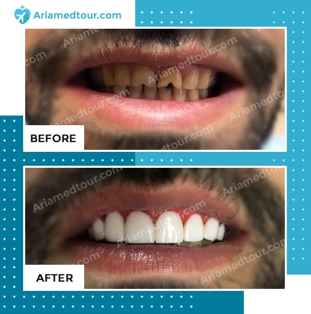 dentistry before after photo in iran