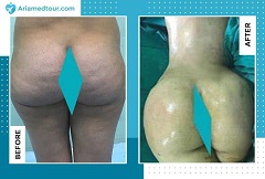 Liposuction before after photo