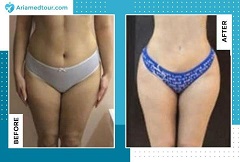 Liposuction before after photo