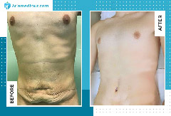 Liposuction vs Tummy Tuck: Which One is Right For You?